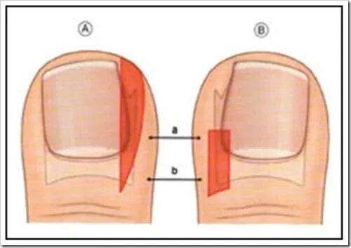Отросший ноготь на большом пальце