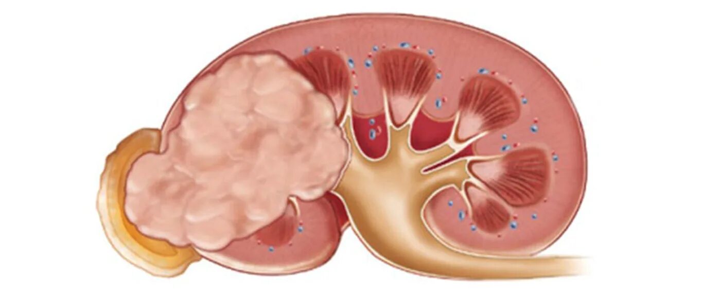 Есть ли рак почки. Опухоли почечной паренхимы. Доброкачественная опухоль почечной лоханки. Злокачественное новообразование почки. Злокачественная опухоль почки.