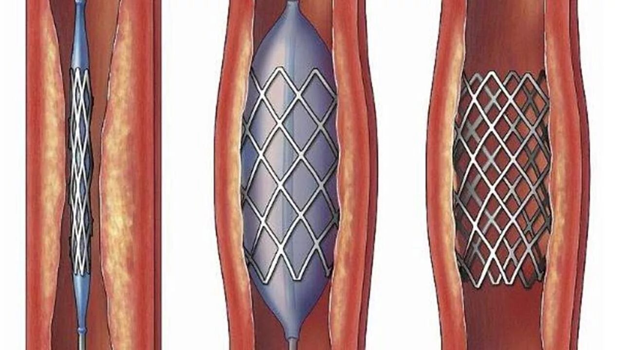 Стент виды. Баллонная ангиопластика. Баллонная коронарная ангиопластика. Чрескожная ТРАНСЛЮМИНАЛЬНАЯ баллонная коронарная ангиопластика.. ТРАНСЛЮМИНАЛЬНАЯ баллонная ангиопластика аорты.
