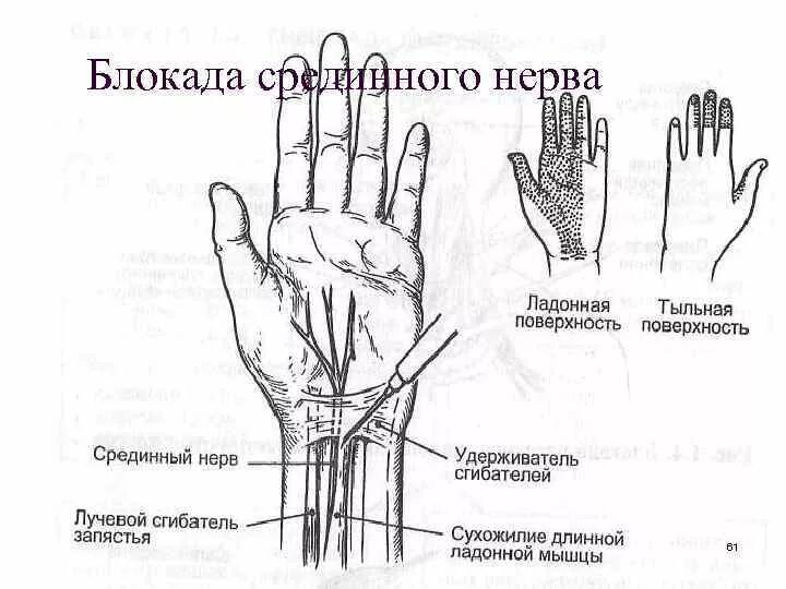 Нервная блокада. Проводниковая анестезия лучевого нерва. Блокада срединного нерва методика. Блокада при синдроме запястного сустава техника. Проводниковая анестезия локтевого нерва.