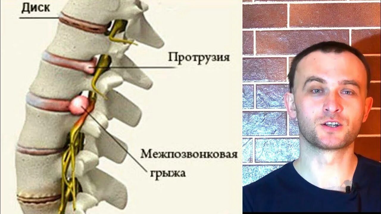 Протрузия диска. Протрузии дисков позвоночника. Протрузия межпозвонковых дисков. Протрузия межпозвонковых упражнения.