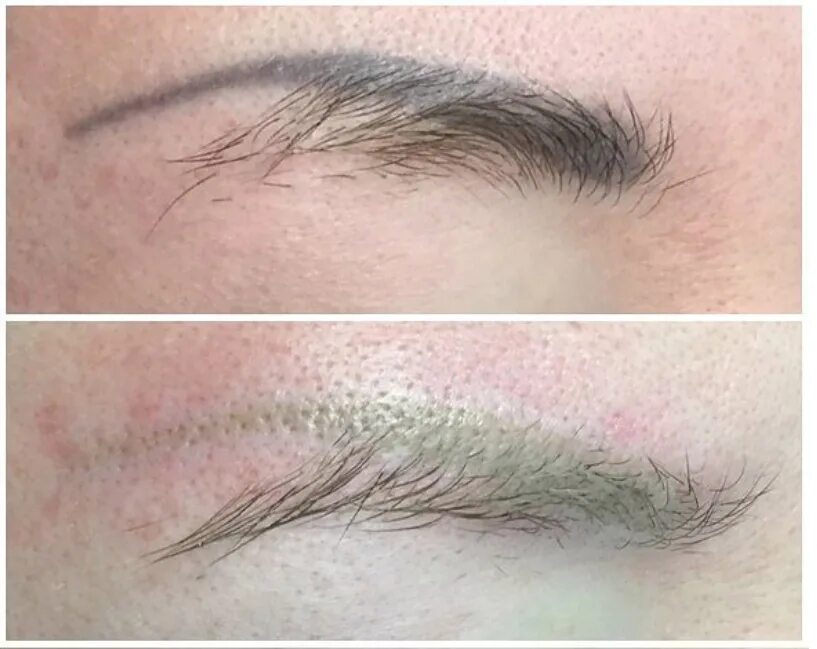 сведение татуажа