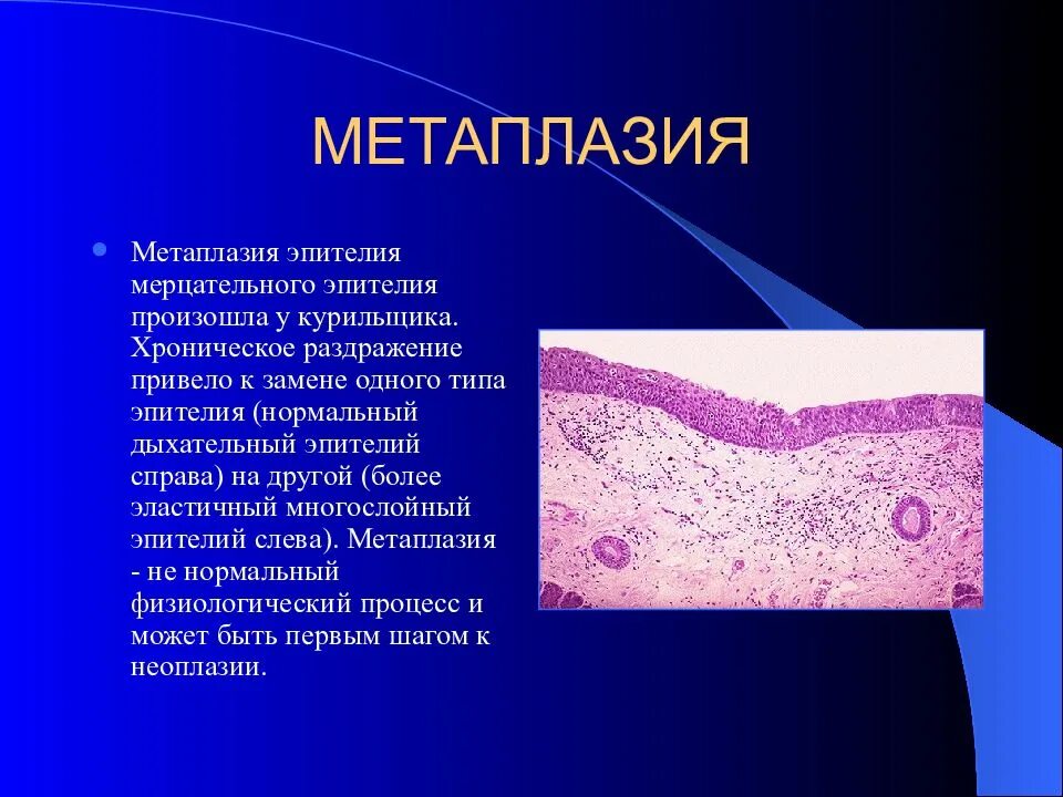 Плоскоклеточная метаплазия эпителия бронха. Метаплазия мерцательного эпителия. Метаплазия призматического эпителия. Клетки метапластического эпителия. Группы клеток метаплазированного