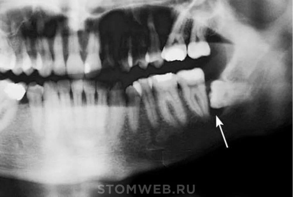 Костные выступы нижней челюсти. Контур нижнего очертания подбородка криминалистика. Деление верхнечелюстной пазухи по онгрену. Слюнные железы при эпид паротите. Ретинированный зуб мудрости рентген.