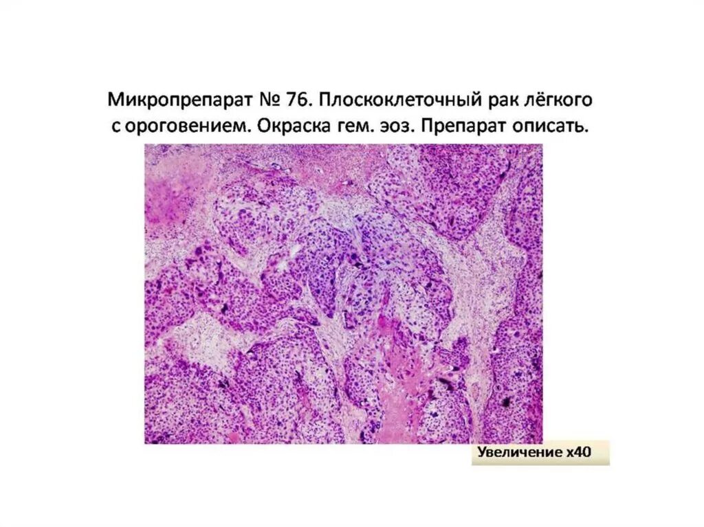 Плоскоклеточными опухолями. Гриппозная пневмония микропрепарат. Плоскоклеточная карцинома кожи гистология. Макропрепарат легкого Патан. Плоскоклеточная карцинома легкого гистология.