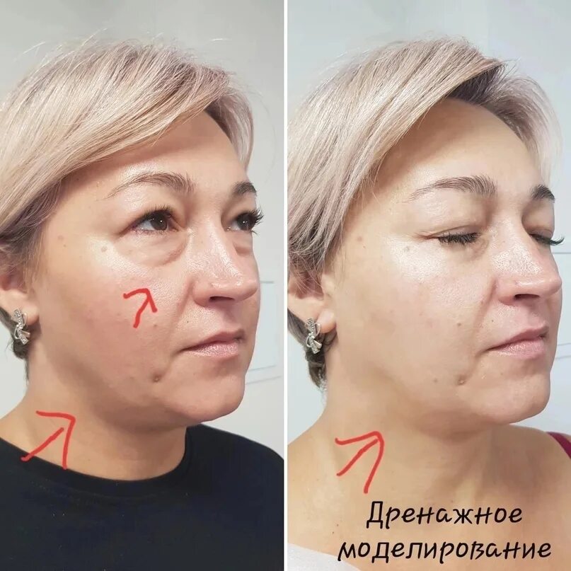 V lift aravia. Дренажное моделирование. Дренажное моделирование лица аравия картинки. Дренажное моделирование. Дренажное моделирование.