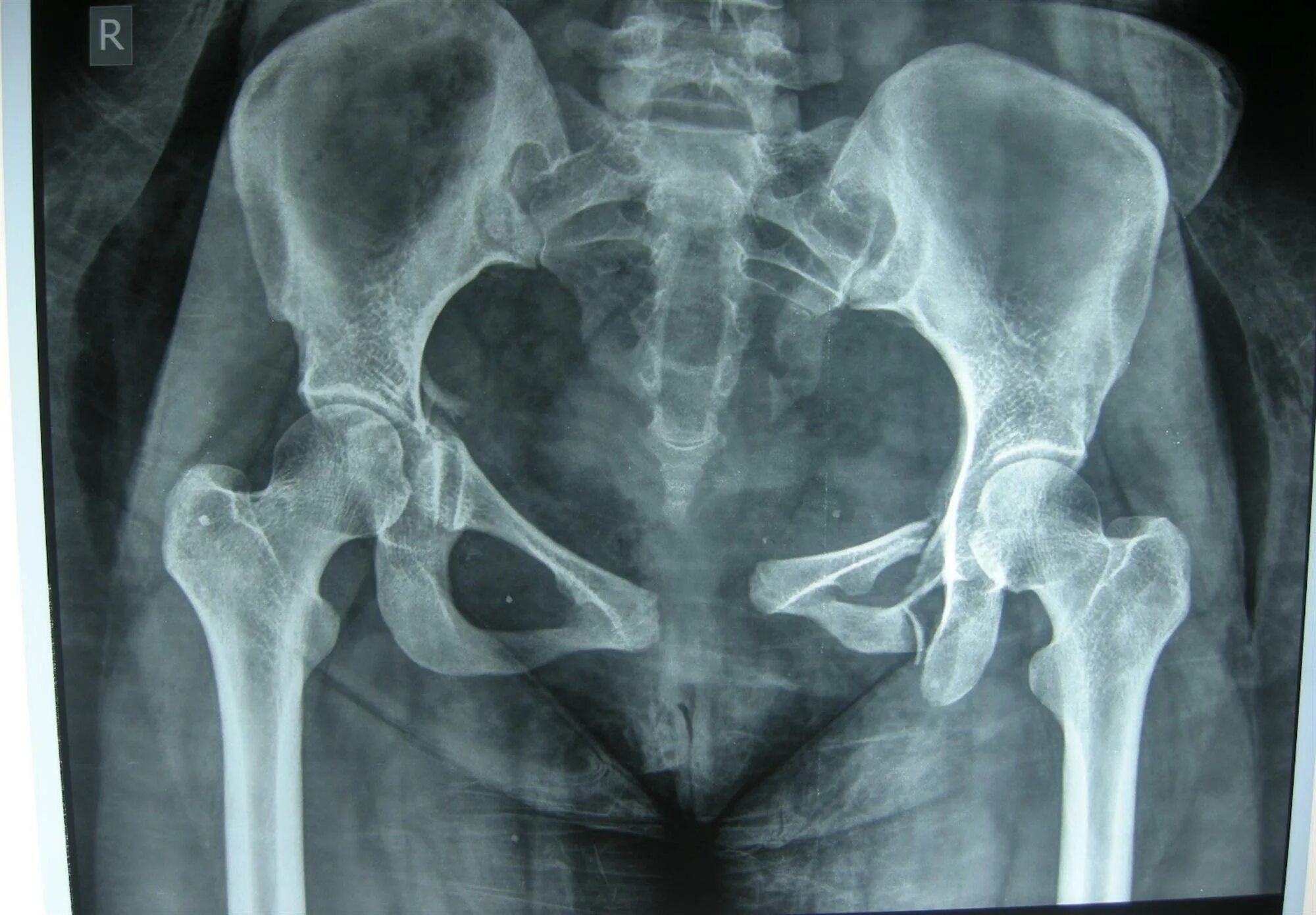 Source x rays