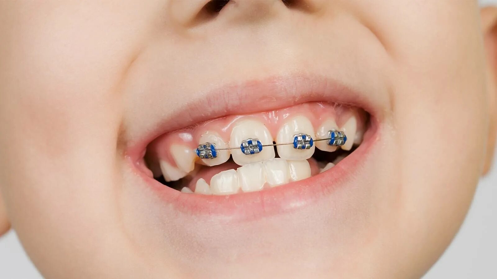 Частичная брекет-система 2x4. Частичная брекет система 2 на 4. Брекеты на зубы для детей сколько стоят