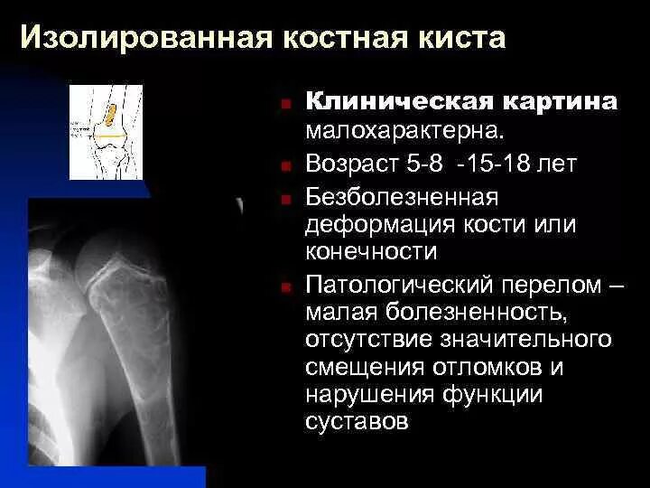 Перелом шейки бедра мкб 10 у взрослых. Костная киста дистального метаэпифиза бедренной кости. костная киста шейки бедренной кости на кт. костная киста в метафизе бедренной кости. киста левой бедренной кости.