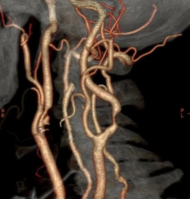 Сужение шейных сосудов. Кт ангиография аневризма. Кт ангиография аневризма головного мозга. Стеноз сонной артерии ангиограмма. Ангиография аневризма сонной артерии.