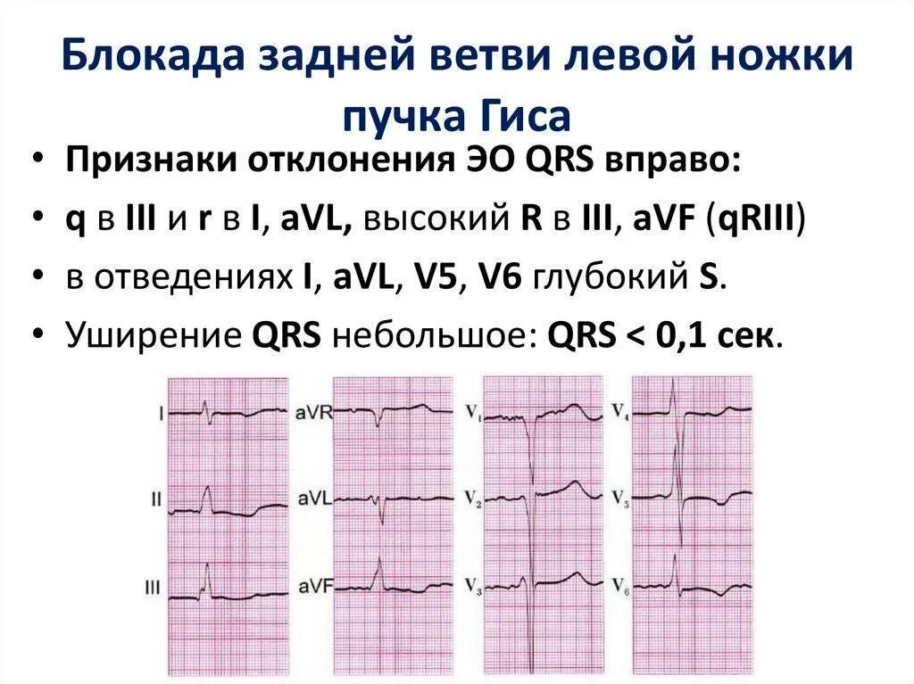 Блокада передне лнпг. Блокада правой и левой ножки пучка Гиса на ЭКГ. Блокады ветвей пучка Гиса на ЭКГ. Неполная блокада левой ножки пучка Гиса на ЭКГ. Признаки неполной блокады левой ножки пучка Гиса на ЭКГ.