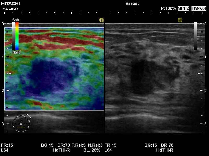 УЗИ щитовидной железы с эластографией. Эластография щитовидной железы что это такое. УЗИ молочных желез эластография. Tsukuba эластография.