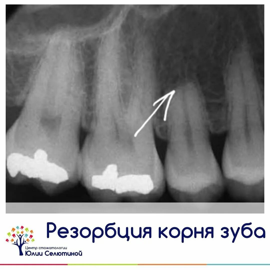 Апикальная резорбция корня. Патологическая резорбция корня молочного зуба. Резорбция корня зуба на снимке.