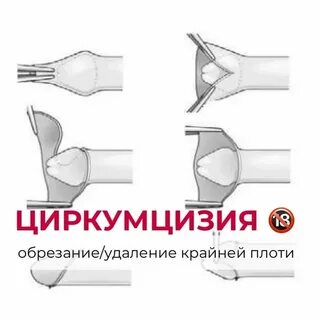 Плюсы делать обрезание у мужчин