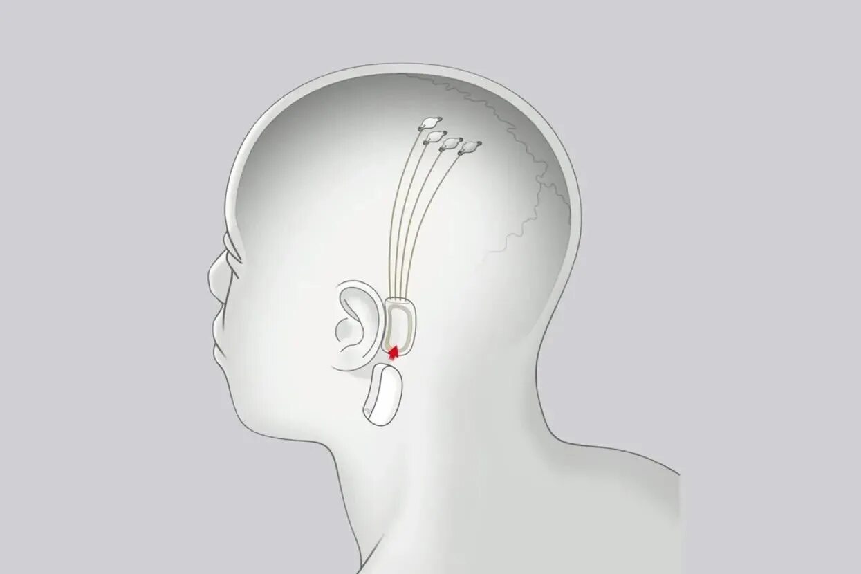 Илон маск имплант. Neuralink чип. Neuralink - чипы маска.