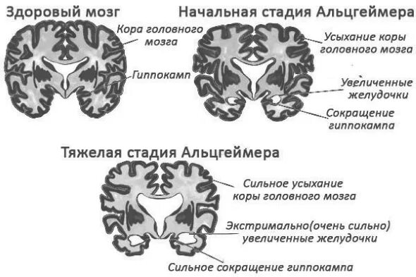Как развивается альцгеймер. Стадии болезни альцгеймера. мозг при болезни альцгеймера. болезнь альцгеймера схема. стадии деменции альцгеймера.