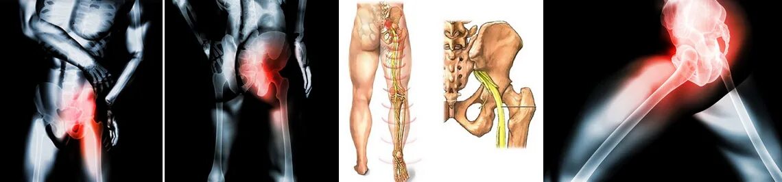 Сильно болит седалищный нерв. Седалищный нерв Лесера. Ишио защемление. Защемление седал.нерва. Ишиас тазобедренного сустава.