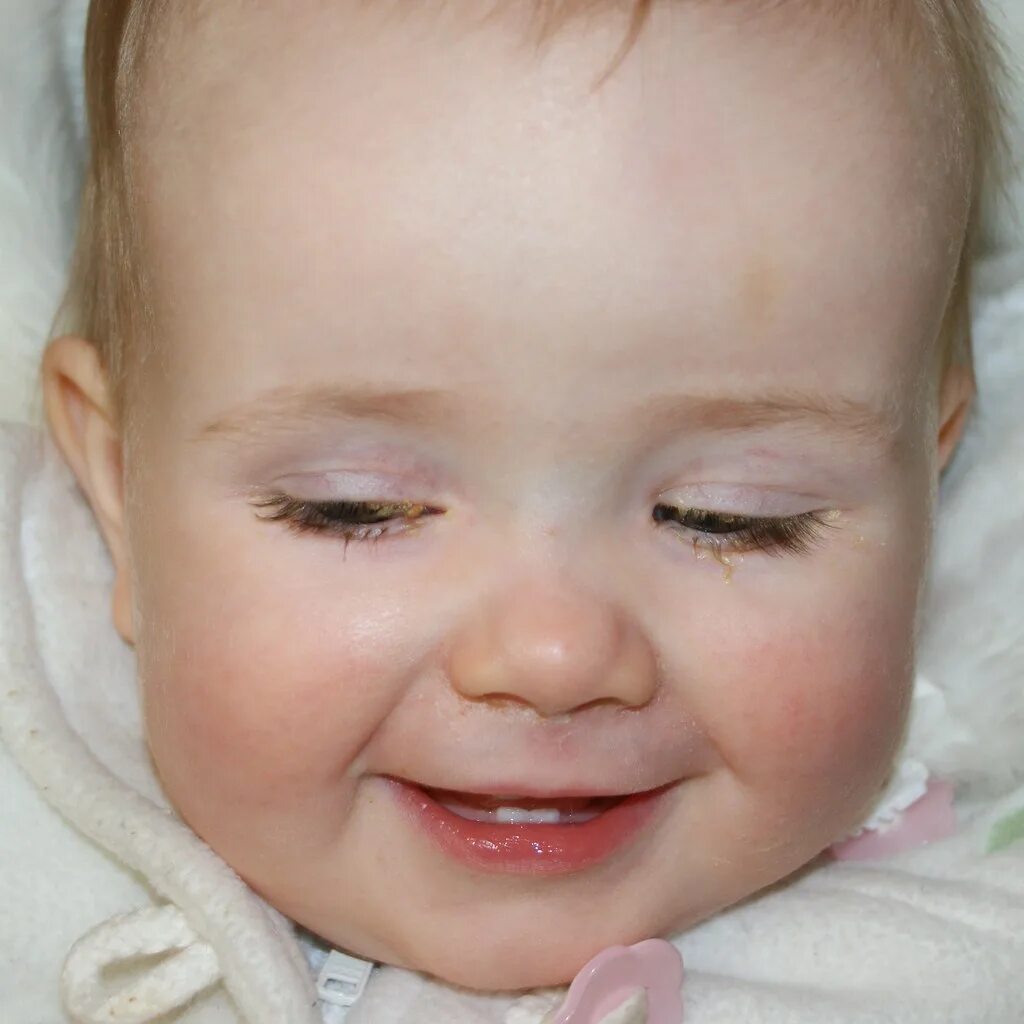 Профилактика глаз новорожденного. Конъюнктивит у новорожденных. Конъюнктивит у грудного ребенка. Детский конъюнктивит у новорожденного.