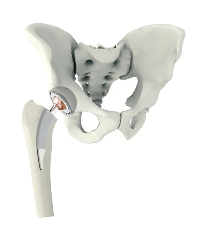 Эндопротезирование тазобедренного сустава Smith nephew. Тазобедренный эндопротез Зиммер. Эндопротезирование тазобедренного сустава Зиммер. Эндопротез тазобедренного сустава Zimmer.