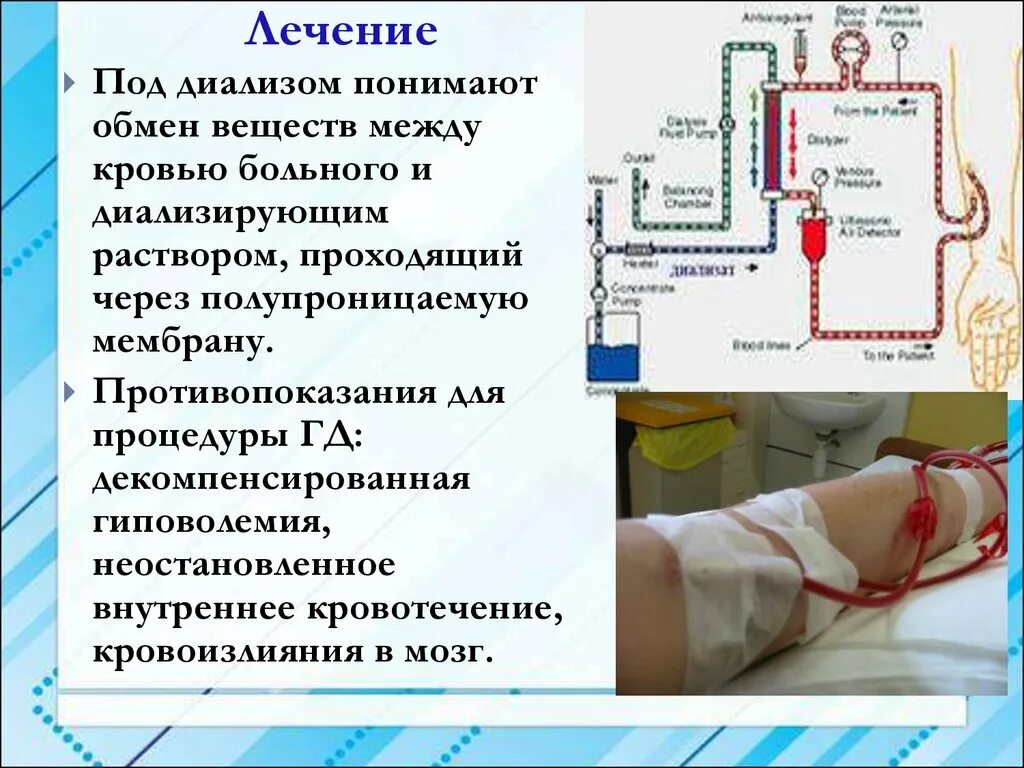 Диализ операция. Диализ схема проведения. искусственная почка для гемодиализа.