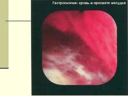 Кровоизлияние живота