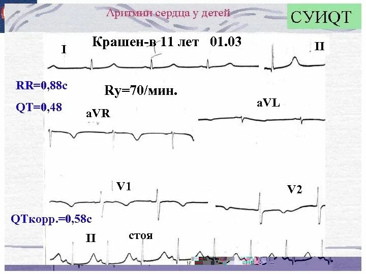 Удлиняющих интервал qt что это. Удлиняющих интервал qt что это
