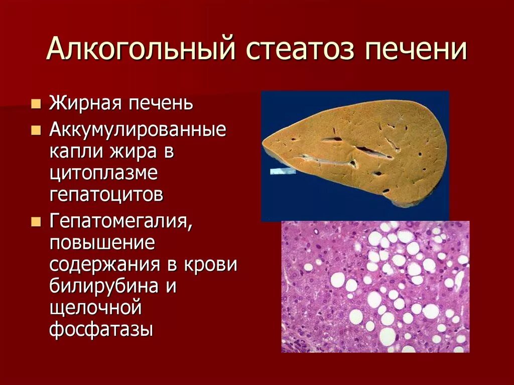 Ранние стадии печени. Жировой гепатоз (стеатоз) печени. Жировой гепатоз печени гистология. Неалкогольный стеатоз печени. Жировая дистрофия печени (стеатоз печени).