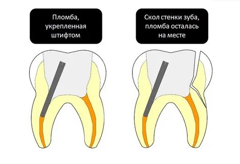 Штифты на шатающиеся зубы