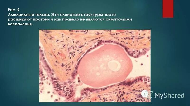 амилоидные тельца в секрете простаты микроскопия. микроскопическое исследование секрета предстательной железы. амилоидные тельца спермограмма. амилоидные тельца в секрете простаты. амилоидные тельца в соке простаты.