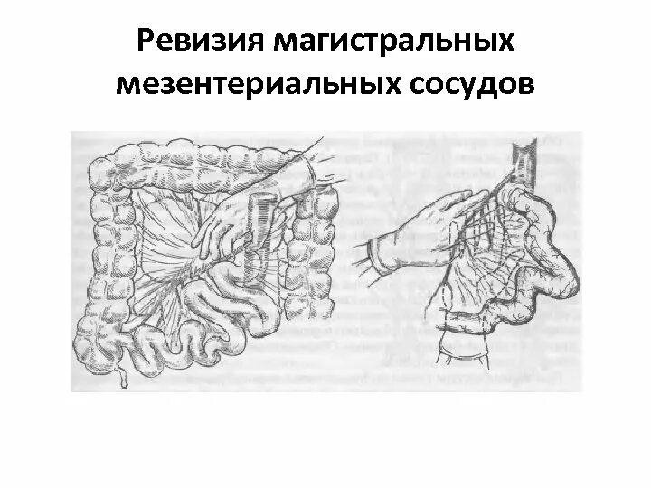 Мезентериальная ишемия. Мезентериальный тромбоз гистология. Мезентериальный тромбоз кишечника. Мезентериальный тромбоз кишечника гистология. Мезентериальный тромбоз тактика.