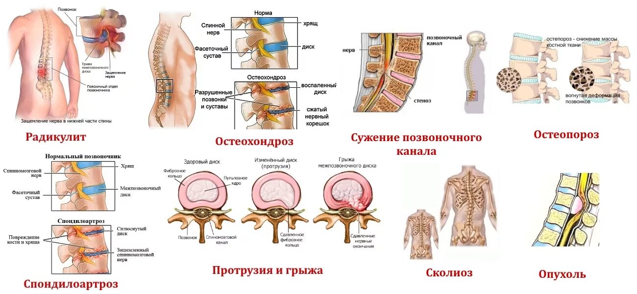 Симптомы поясничного крестцового отдела позвоночника. Грыжи позвоночника в поясничном отделе схема. Заболевания пояснично-крестцового отдела позвоночника. Остеохондроз, протрузия, грыжа межпозвоночного диска. Дорсопатии поясничного отдела позвоночника.