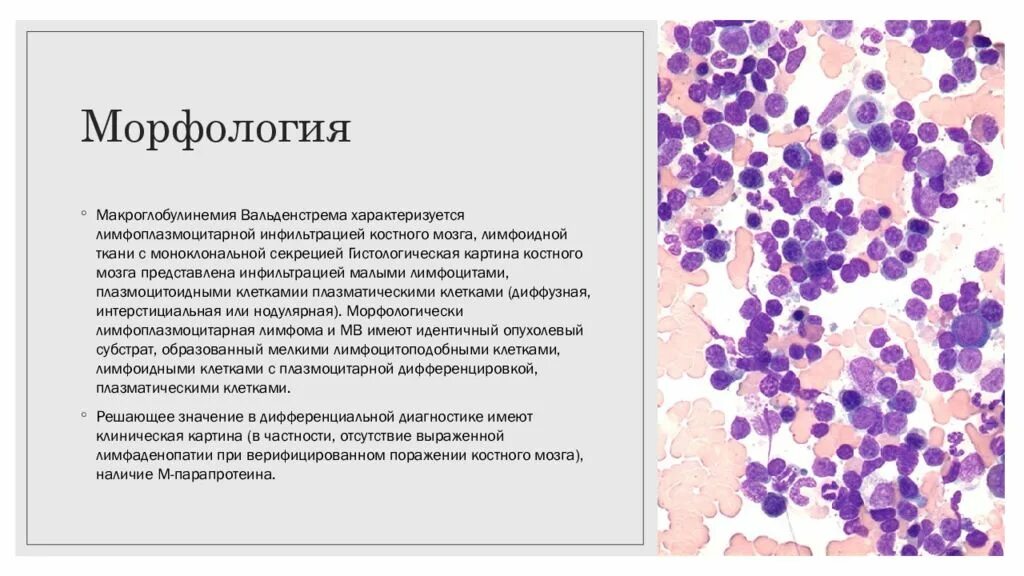 Лимфоидная инфильтрация что это. Лимфоидная инфильтрация гистология. Макроглобулинемия Вальденстрема. Макроглобулинемия Вальденстрема костный мозг. Макроглобулинемия Вальденстрема костный мозг гистология.