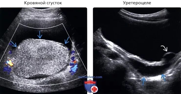 Сгустки в мочевом пузыре на УЗИ. Сгусток в полости мочевого пузыря УЗИ. Образования мочевого пузыря на УЗИ. Сгусток крови в мочевом пузыре на УЗИ.