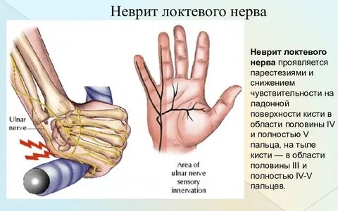 Невралгия кистей