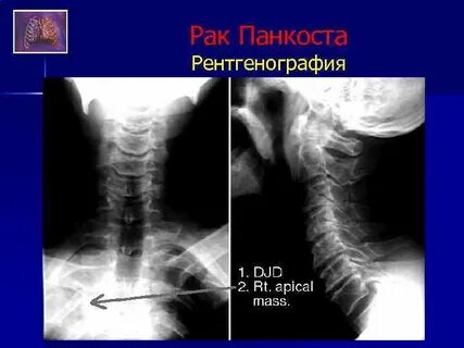 Рак панкоста
