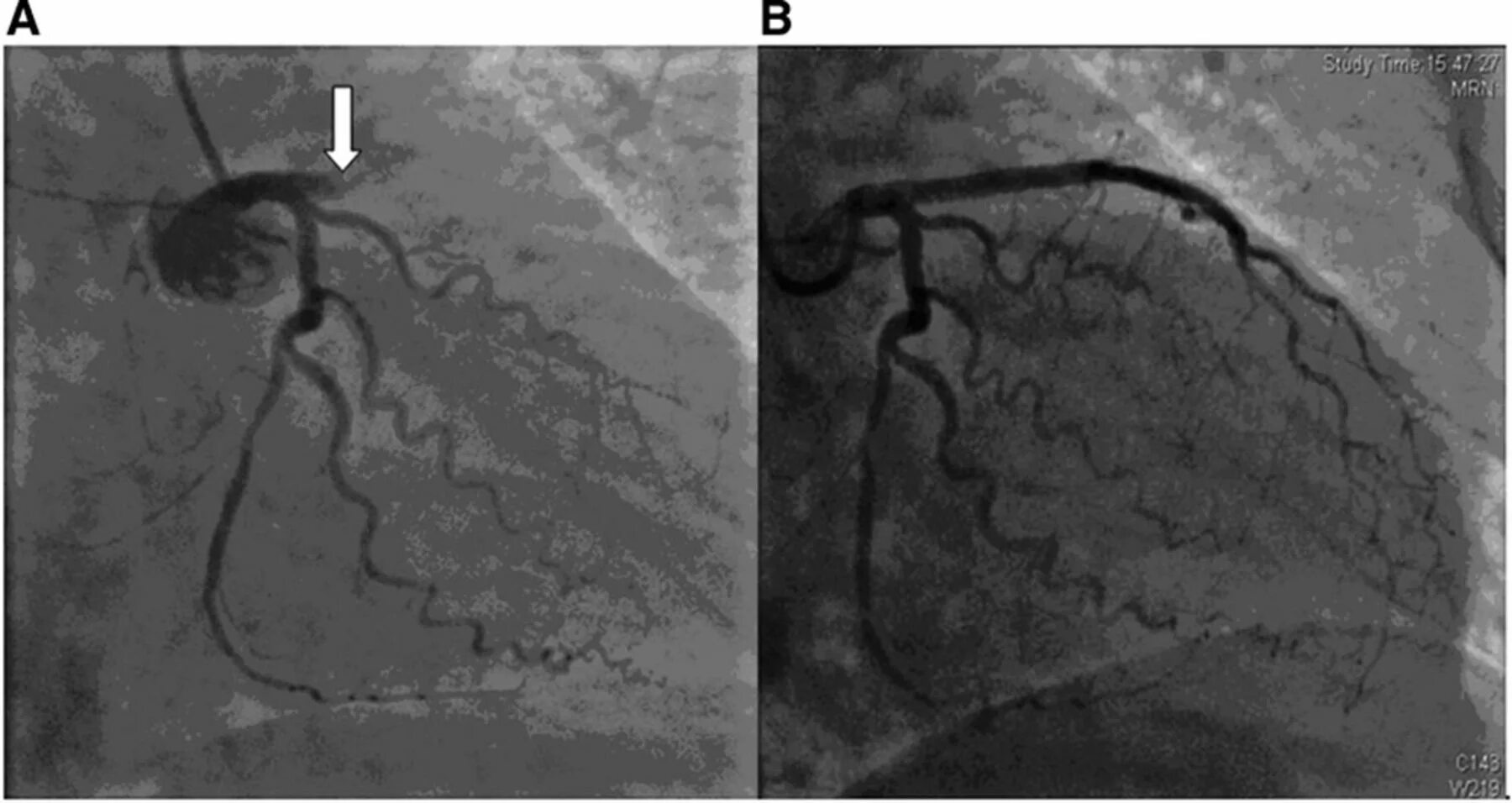 Стентирование пмжв. Стентирование пмжв. Стеноз коронарных артерий стентирование. Коронарография стентирование. Коронарография стеноз пмжв.