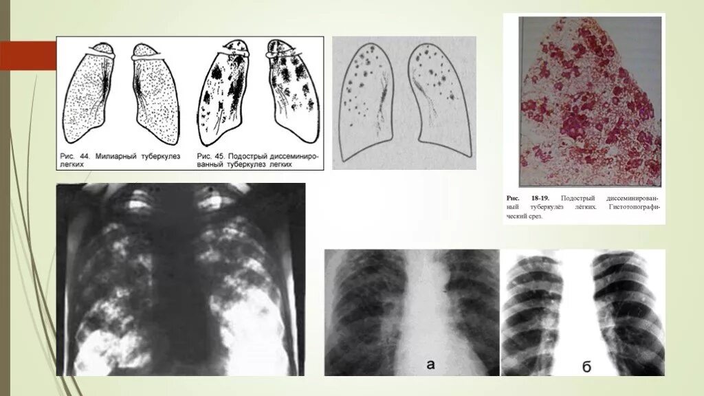Старый туберкулез. Милиарный туберкулез синдромы. Хронический диссеминированный туберкулез легких кт. Милиарный диссеминированный туберкулез рентген. Подострый диссеминированный туберкулез рентген.