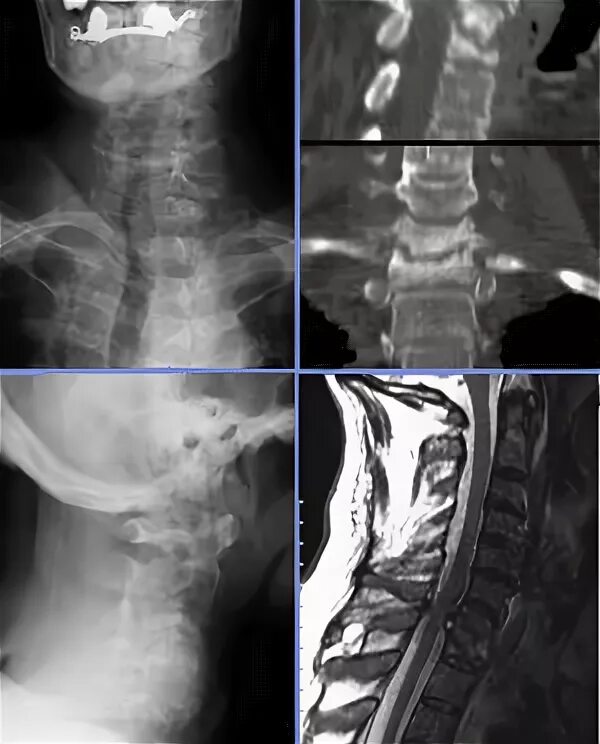асептический спондилит с5-с6. спондилит шейного отдела рентген. асептический спондилит шейного отдела позвоночника. анкилозирующий спондилит кт. анкилозирующий спондилоартрит болезнь бехтерева.