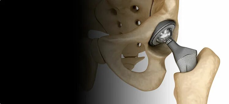 Сайт центра эндопротезирования чебоксары. Артусмед эндопротезирование тазобедренного сустава Чехия. Смоленск эндопротезирование. Германский эндопротез тазобедренного.