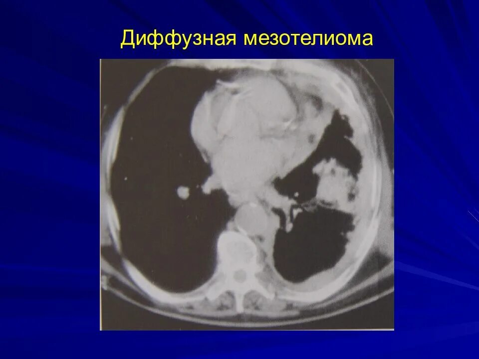 Мезотелиома плевры дифференциальная диагностика. Мезотелиома междолевой плевры. Мезотелиома брюшины кт. Мезотелиома плевры брюшины и других локализаций. Мезотелиома плевры брюшины и других локализаций.
