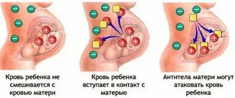 Резус несовместимость