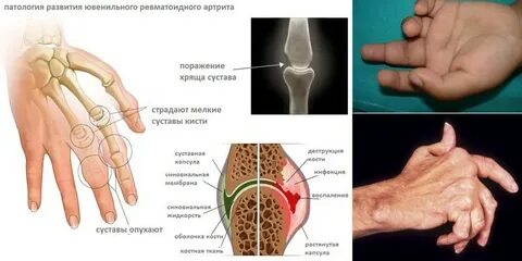 Ювенильный артрит клинические рекомендации