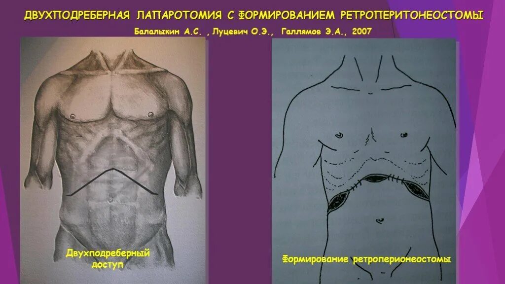 Какое лапаротомия. Двухподреберная лапаротомия. Поперечная лапаротомия. Двухподреберный доступ. Средне срединная лапаротомия.