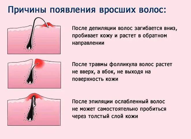 Перечислите типы вросших волос. Волосы ломаются и выпадают. Причины тонкого волоса у женщины. Выпадение волос с луковицей. Строение волоса чешуйки.