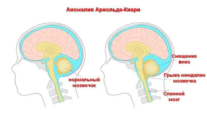 Аномалия киари степени. Аномалия Арнольда Киари 1 типа мрт головного мозга. Аномалия Арнольда-Киари 1 степени у детей. Мальформация Арнольда-Киари 1 типа. Аномалия Арнольда Киари 1 степени что это такое.