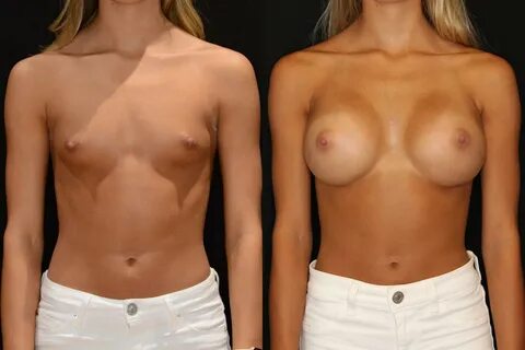 Orange county breast implants before and after