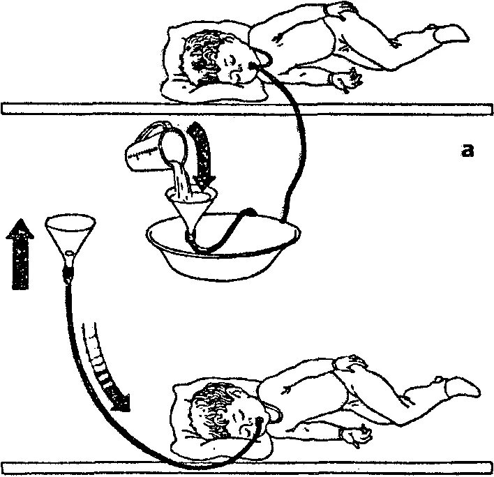 Зондовое промывание желудка. Промывание кишечника Кружка Эсмарха. Очистительная клизма схема. Постановка клизмы картинки.