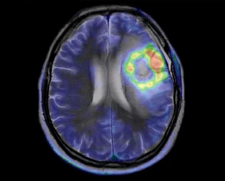 Позитронно-эмиссионная томография мозга. ПЭТ кт головного мозга. Петкате головного мозга. ПЭТ/кт головного мозга Альцгеймера.