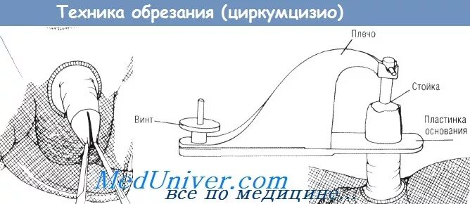 Как делают обрезание схема. Методика операции циркумцизио. Плюсы и минусы обрезания крайней плоти