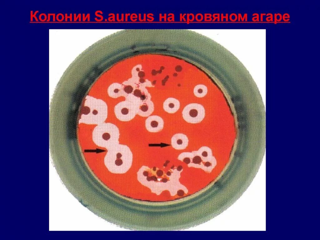 Стафилококк спп. Стафилококк на кровяном агаре. стафилококк ауреус на кровяном агаре колонии. колонии золотистого стафилококка на кровяном агаре.
